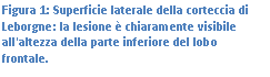 Text Box: Figura 2: Superficie laterale della corteccia di Leborgne: la lesione  chiaramente visibile all'altezza della parte inferiore del lobo frontale.