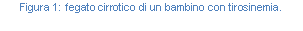 Text Box: Figura 29: fegato cirrotico di un bambino con tirosinemia.