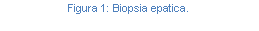 Text Box: Figura 33: Biopsia epatica.