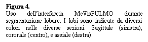 Text Box: Figura 4.  
Uso dell'interfaccia MeVisPULMO durante segmentazione lobare. I lobi sono indicate da diversi colori nelle diverse sezioni. Sagittale (sinistra), coronale (centro), e assiale (destra). 
