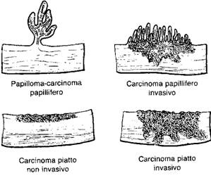 Papilloma invertito vescicale. Il papilloma alla vescica e benigno