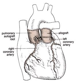 Ross Procedure diagram C